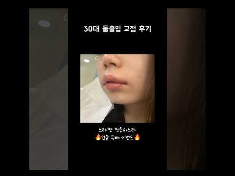 2년 1개월 걸린 돌출입 교정 후기 가지고 왔습니다요😬 30대 성인 치아교정 후기 #shorts
