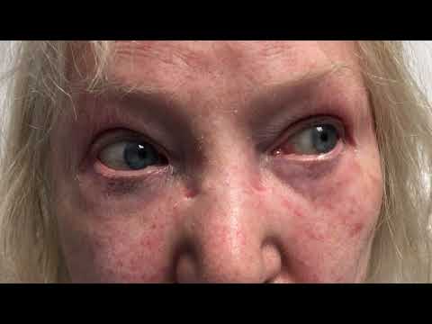 Can nystagmus that changes direction with gaze ever be benign?