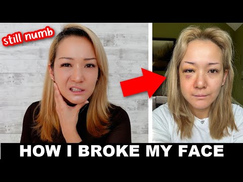 How I Broke My Face (While Traveling with My 1 Year Old)