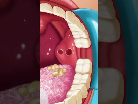 Relaxing ASMR Mouth Cleaning – Fresh & Healthy #SmilePlaqueRemoval #HealthySmile