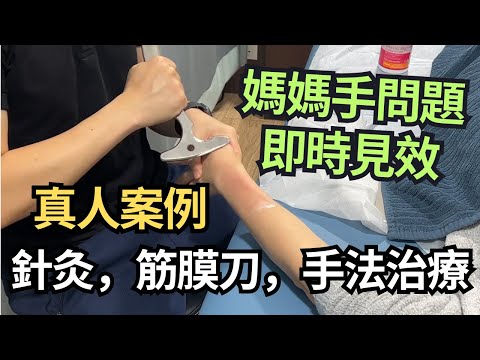 【媽媽手治療過程】一堂物理治療內即時見效，主力用手法治療，包含針灸、拔罐、筋膜刀｜吳子謙物理治療師｜凝聚物理治療中心｜Together Physio