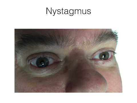 A Basic, Simplified Approach to the Dizzy Patient Part 2