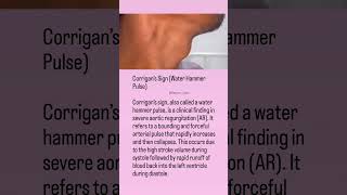 "Corrigan's Sign Explained: A Classic Sign of Aortic Regurgitation!" #education #shorts #health #seo