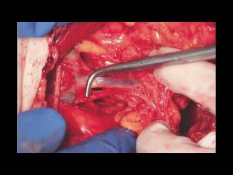 Modified Radical Mastectomy (MRM) @LankaraniMD