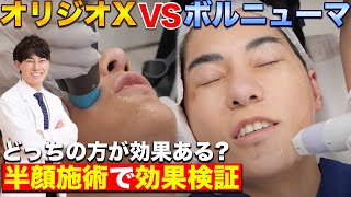 【検証】高周波治療最強はどっち？オリジオXとボルニューマを半顔ずつ受けて効果検証！