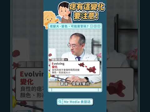 痣「變這樣」可能代表癌變？5徵兆要記牢！