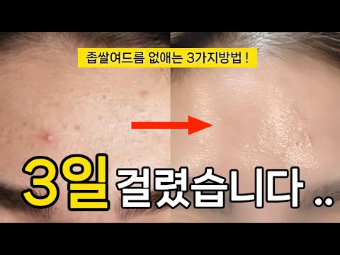광고❌ only 홈 케어, 지긋지긋한 좁쌀여드름 없애는 방법 | 여드름, 속건조, 유수분밸런스 다 잡는 방법