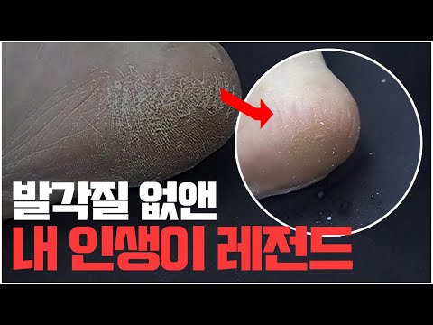 발각질 없앤 내가 ★위너★ 이겼다!