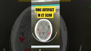 Ring artifact in ct scan #radiologycareer #viralshort #radiographer #ctscan#artifacts #medicalcourse