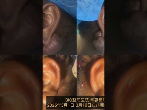 #비아이오성형외과 #아프리카#무료진료#신용호원장