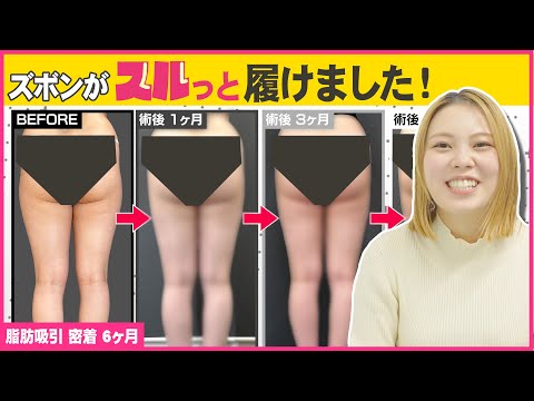 【整形レポ】夏は自信を持って足を出せます！脂肪吸引で太ももを長く！細く見えるすらっと美脚に！