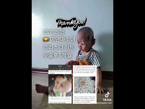 #미얀마소녀#크리스티하트#수술후6개월#잘지내고있어요#비아이오성형외과신용호