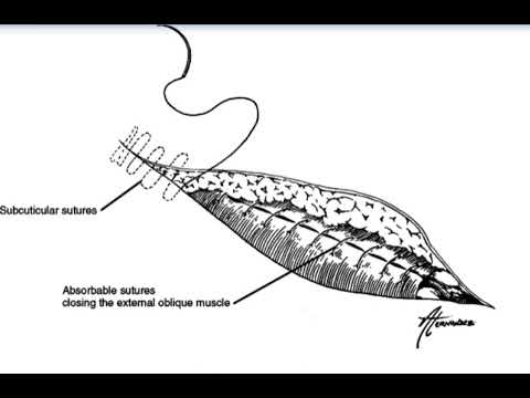 Inguinal Hernia Repair Animated 🎬 #Surgery #Animation #Hernia #Medicine #Health