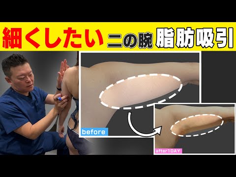ふりそでがダイエットで落ちない‼️二の腕コンプレックスを脂肪吸引で解消！！