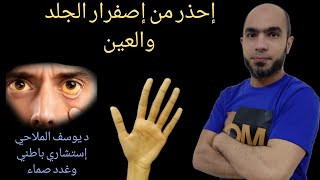 ما سبب الصفراء المتكررة؟@Dr_youssef