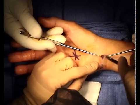 CARPAL TUNNEL RELEASE SURGERY
