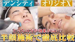 【検証】オリジオXとデンシティどっちの方が効果が高い？半顔施術で徹底比較！