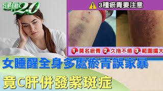 女睡醒全身多處瘀青誤家暴 竟C肝併發紫斑症 健康2.0