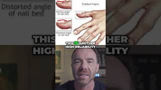 Clubbed Nails: A Warning Sign You Shouldn't Ignore! See a Doctor!
