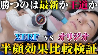 【検証】XERF vs オリジオ！半顔施術で高周波たるみ治療徹底比較！