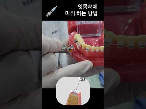 잇몸뼈에 마취는 어떻게 하는 걸까? 골수강내 무통마취