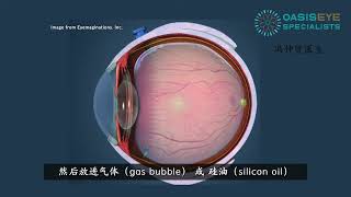 冯仲贤医生 : 视网膜脱落 / Retinal Detachment