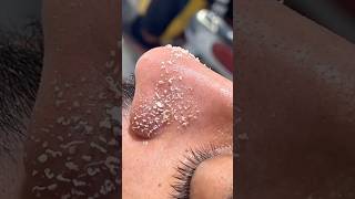 Get Rid Of Blackheads & Whiteheads #blackheads #whiteheads #hack #youtube #diy #video #shorts #viral